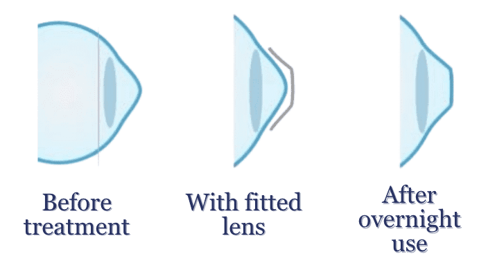 Ortho-K corneal reshaping diagram